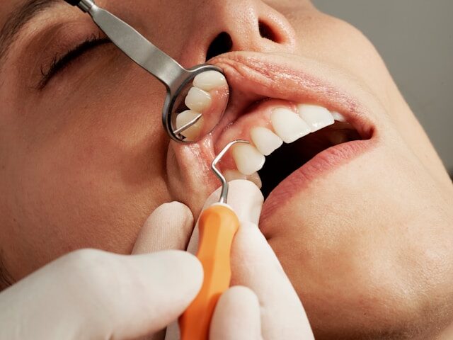 Choosing the Right Dental Bridge: A Guide to Restoring Your Smile
